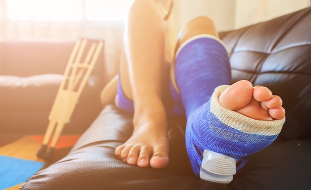 broken leg cast